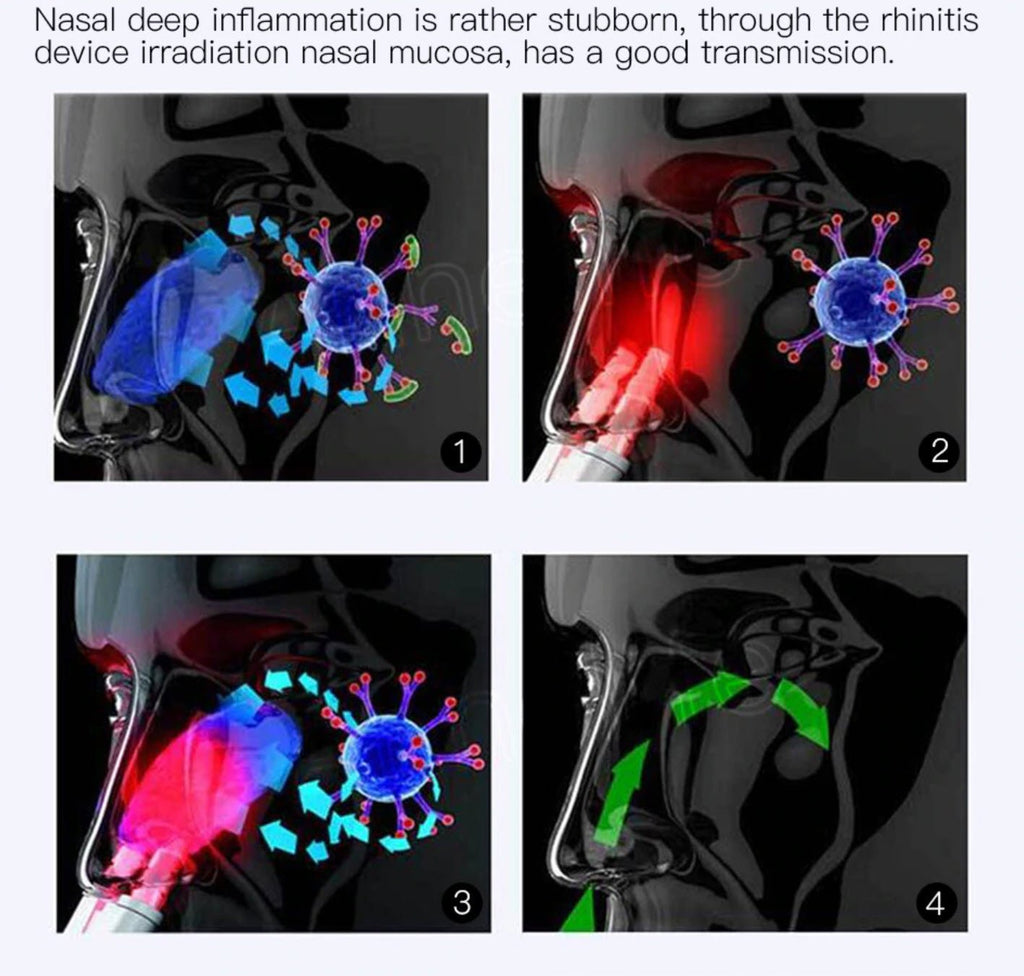 Infrared Rhinitis Therapy Device-CQA9417473196328-564575 CQA9417473196328