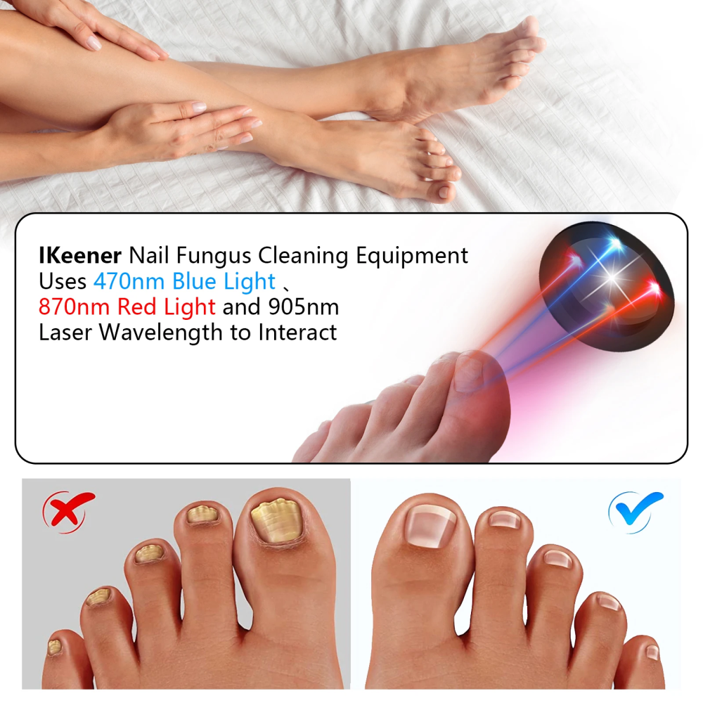 Laser Heal Toenail Fungus Removal Laser-CQA9417459892520-564575 CQA9417459892520