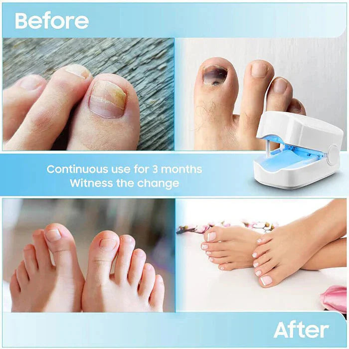 Nail Fungus Cleaning Laser Device - Expert Revolutionary High-Efficiency Light Therapy Device For Toenail Diseases-CQA9417467199784-564575 CQA9417467199784